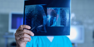 Вебинар «Диагностика интерстициальных изменений легких в практике ревматолога и терапевта», 17 апреля 2025 года