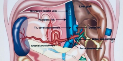 Московские трансплантологи провели уникальную операцию