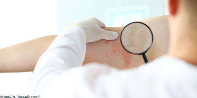 Изучение характеристик специфических инструментов оценки качества жизни при псориазе