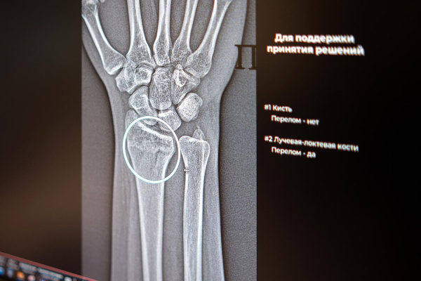 ИИ в помощь рентгенологам