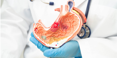 Современные стратегии профилактики рака желудка