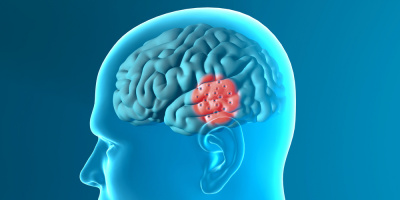 Запись онлайн-лекции «Отек головного мозга» 13 октября